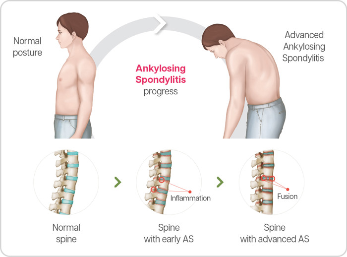 What is Ankylosing Spondylitis (AS)?