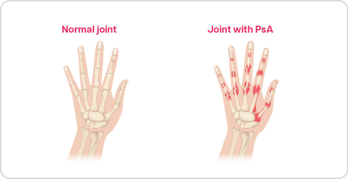 What is Psoriatic Arthritis (PsA)?