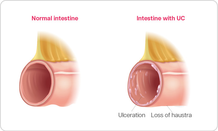 What is Ulcerative Colitis (UC)?