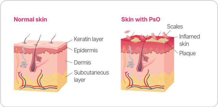 What is Plaque Psoriasis (PsO)? 1