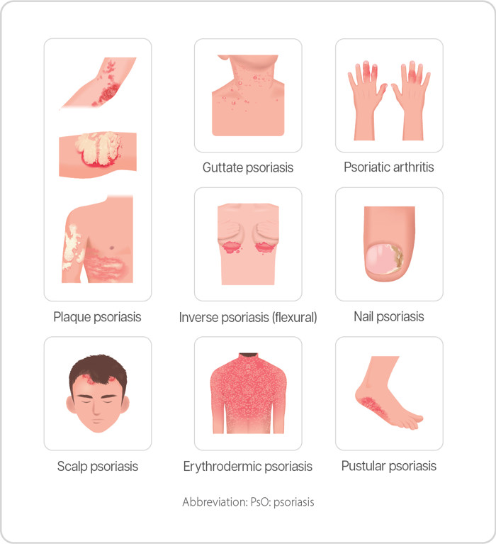 What is Plaque Psoriasis (PsO)? 2